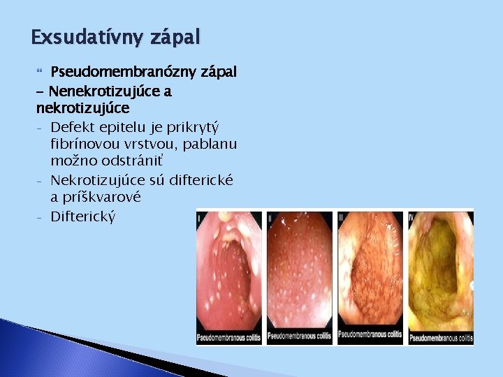 Exsudatívny zápal Pseudomembranózny zápal - Nenekrotizujúce a nekrotizujúce - Defekt epitelu je prikrytý fibrínovou