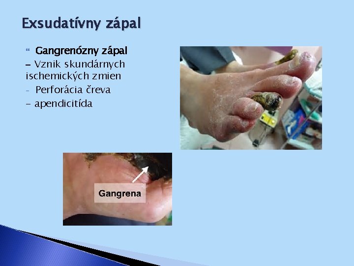 Exsudatívny zápal Gangrenózny zápal - Vznik skundárnych ischemických zmien - Perforácia čreva - apendicitída