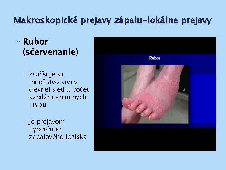 Makroskopické prejavy zápalu-lokálne prejavy Rubor (sčervenanie) ◦ Zväčšuje sa množstvo krvi v cievnej sieti