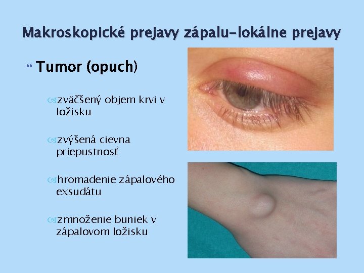 Makroskopické prejavy zápalu-lokálne prejavy Tumor (opuch) zväčšený objem krvi v ložisku zvýšená cievna priepustnosť