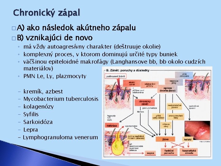 Chronický zápal � A) ako následok akútneho zápalu � B) vznikajúci de novo ◦