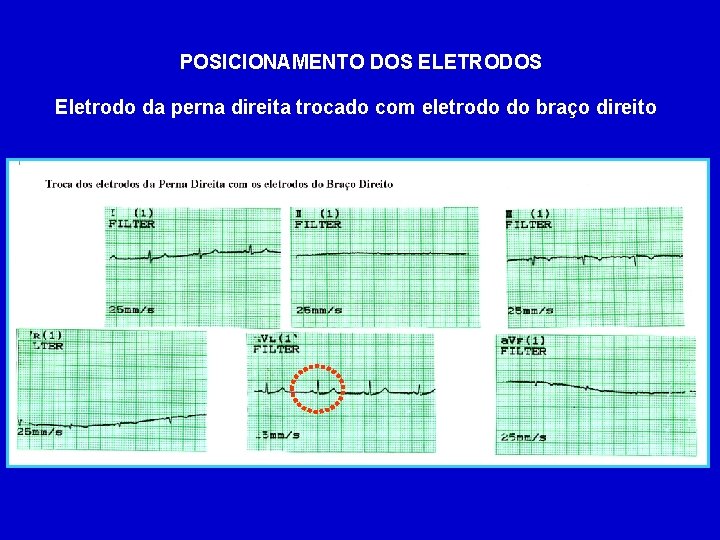 POSICIONAMENTO DOS ELETRODOS Eletrodo da perna direita trocado com eletrodo do braço direito 