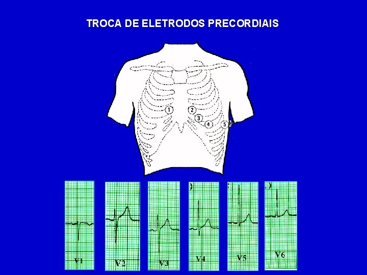 TROCA DE ELETRODOS PRECORDIAIS 