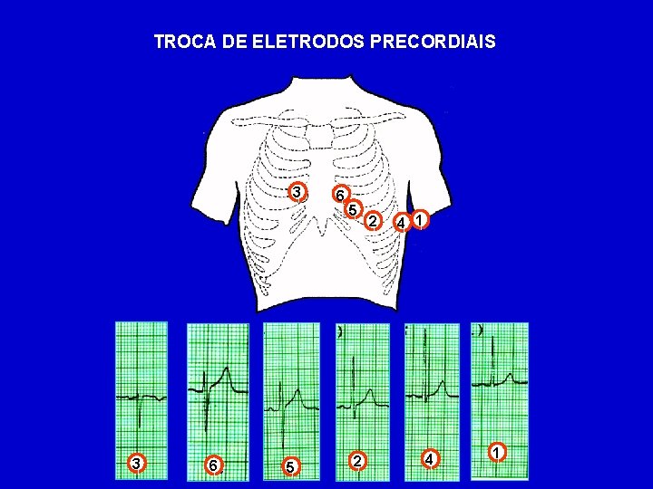 TROCA DE ELETRODOS PRECORDIAIS 3 1 6 1 5 1 2 1 41 1