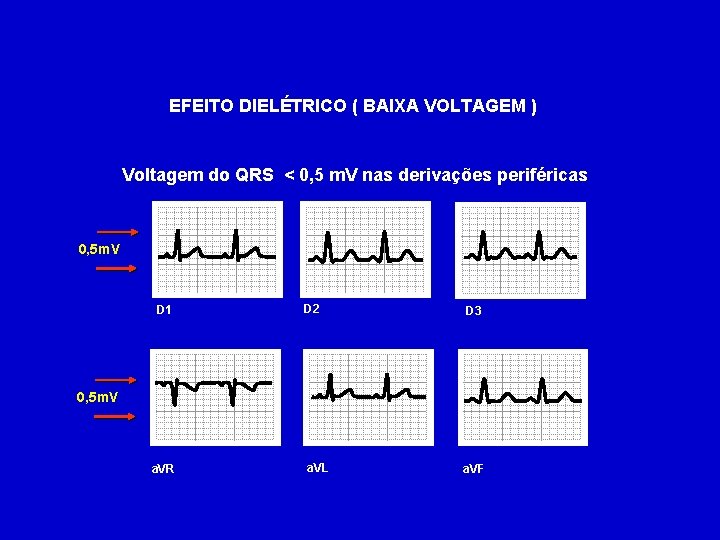 EFEITO DIELÉTRICO ( BAIXA VOLTAGEM ) Voltagem do QRS < 0, 5 m. V