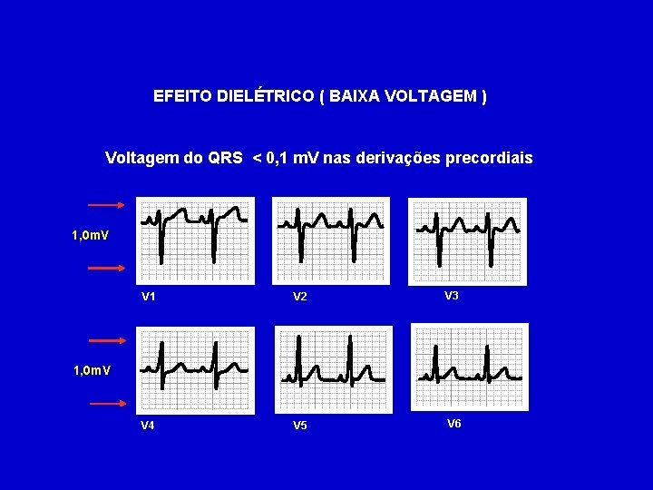 EFEITO DIELÉTRICO ( BAIXA VOLTAGEM ) Voltagem do QRS < 0, 1 m. V