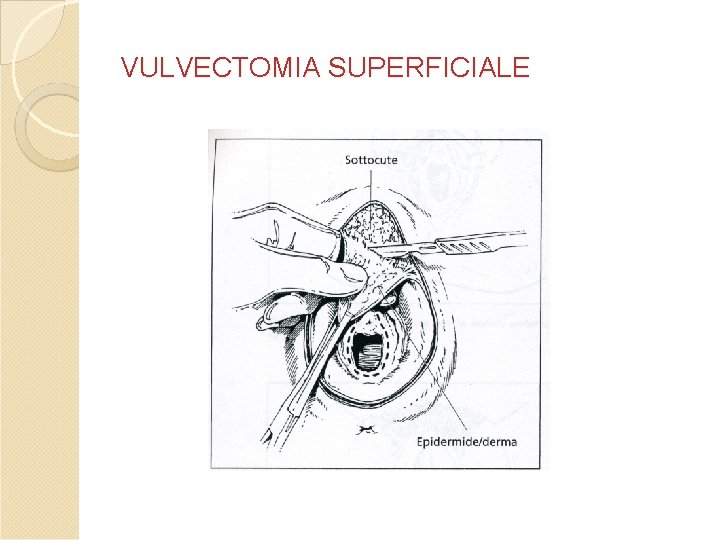 VULVECTOMIA SUPERFICIALE VULVECTOMIA SUPERFICIALE