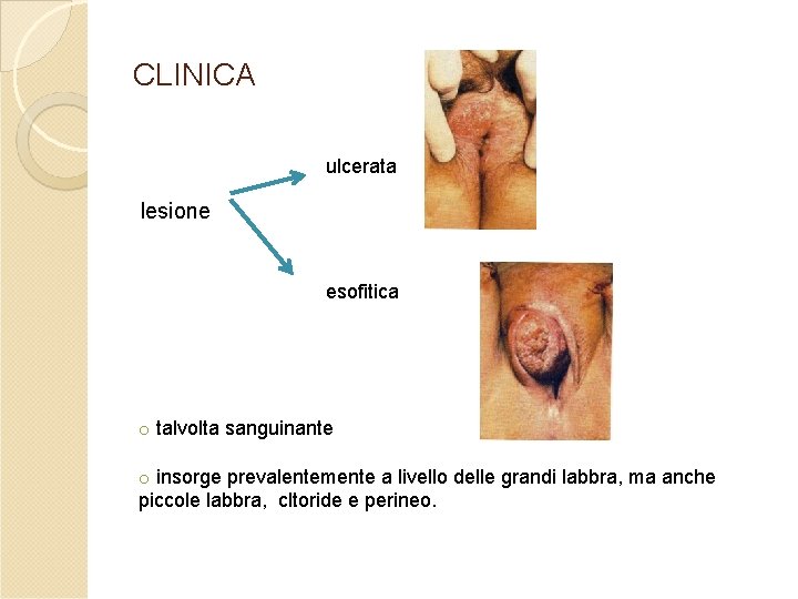 CLINICA ulcerata lesione esofitica o talvolta sanguinante o insorge prevalentemente a livello delle grandi CLINICA ulcerata lesione esofitica o talvolta sanguinante o insorge prevalentemente a livello delle grandi