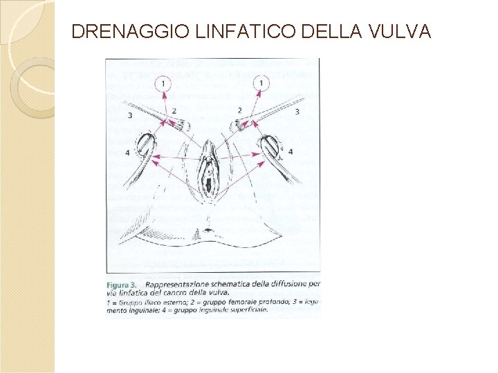 DRENAGGIO LINFATICO DELLA VULVA DRENAGGIO LINFATICO DELLA VULVA
