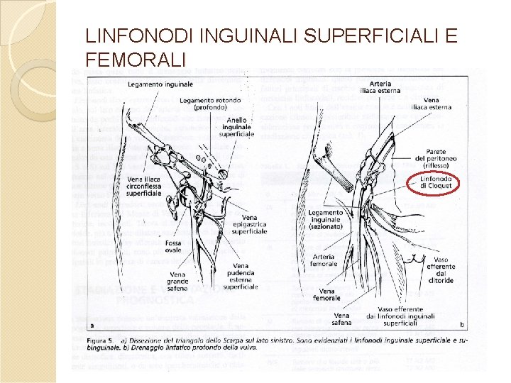LINFONODI INGUINALI SUPERFICIALI E FEMORALI LINFONODI INGUINALI SUPERFICIALI E FEMORALI