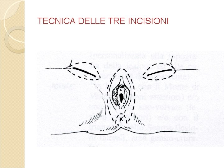 TECNICA DELLE TRE INCISIONI TECNICA DELLE TRE INCISIONI