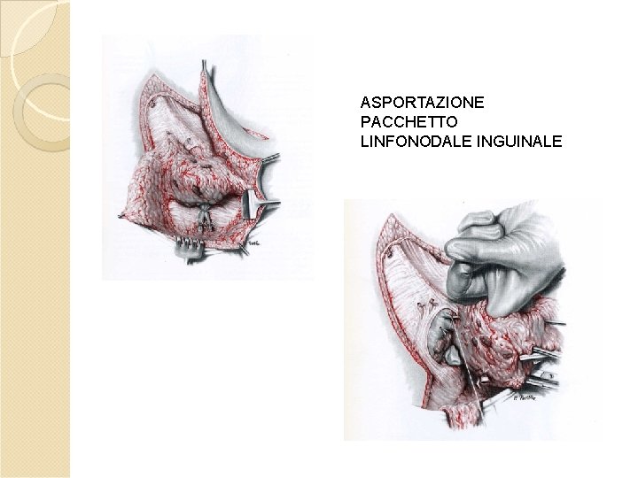 ASPORTAZIONE PACCHETTO LINFONODALE INGUINALE ASPORTAZIONE PACCHETTO LINFONODALE INGUINALE