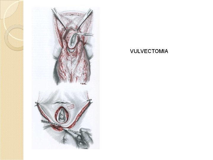 VULVECTOMIA VULVECTOMIA