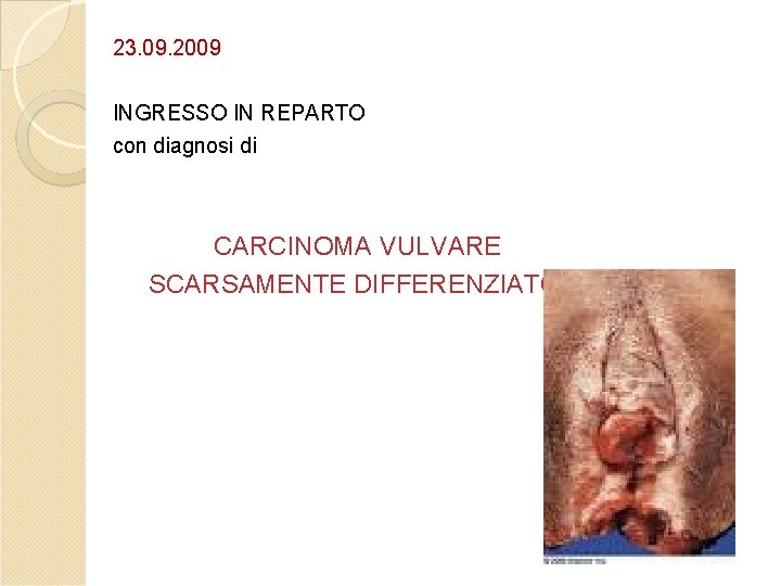 23. 09. 2009 INGRESSO IN REPARTO con diagnosi di CARCINOMA VULVARE SCARSAMENTE DIFFERENZIATO 23. 09. 2009 INGRESSO IN REPARTO con diagnosi di CARCINOMA VULVARE SCARSAMENTE DIFFERENZIATO
