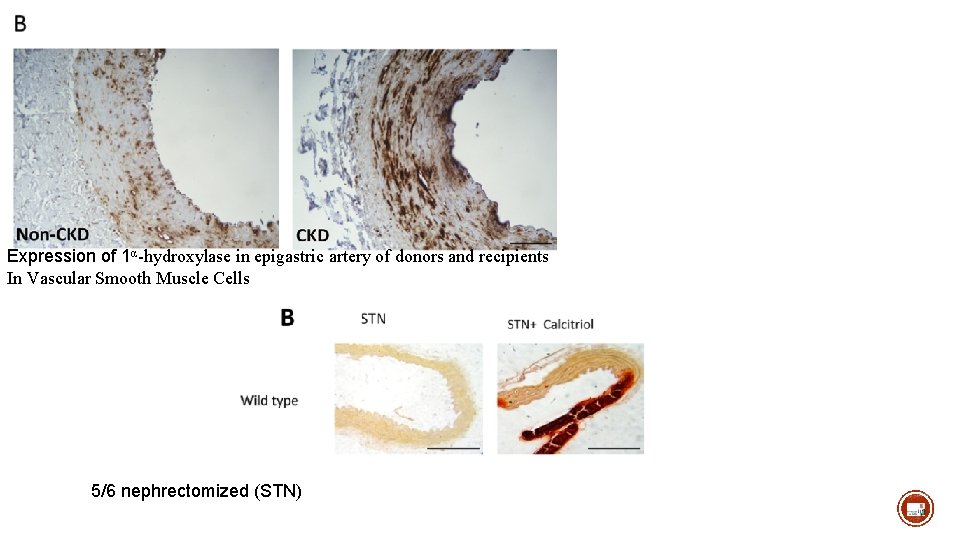 Expression of 1α-hydroxylase in epigastric artery of donors and recipients In Vascular Smooth Muscle