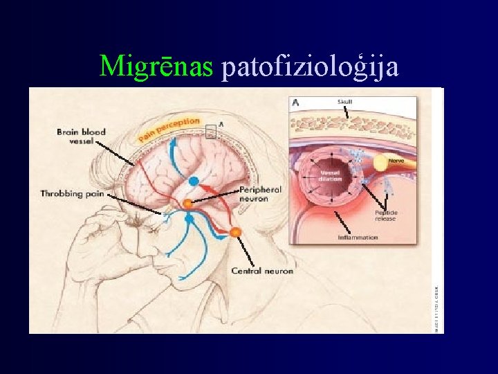 Migrēnas patofizioloģija 