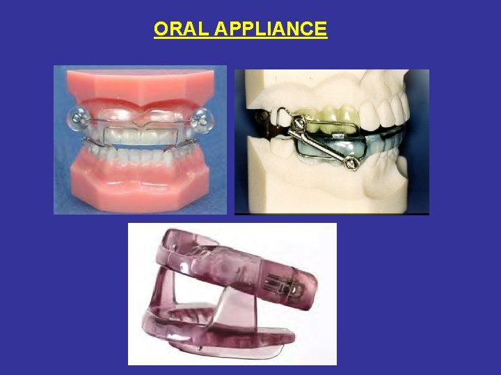 ORAL APPLIANCE 