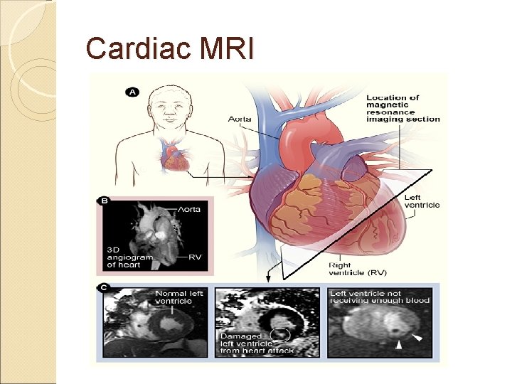 Cardiac MRI 