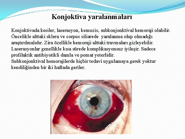 Konjoktiva yaralanmaları Konjoktivada kesiler, laserasyon, kemozis, subkonjonktival hemoraji olabilir. Öncelikle alttaki sklera ve corpus