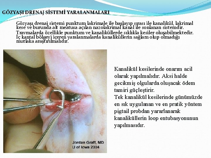 GÖZYAŞI DRENAJ SİSTEMİ YARALANMALARI Gözyaşı drenaj sistemi punktum lakrimale ile başlayıp sırası ile kanalikül,