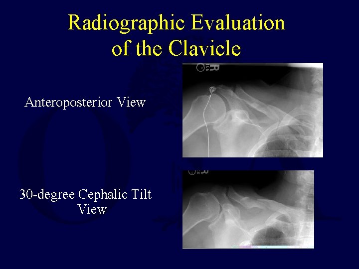 Radiographic Evaluation of the Clavicle Anteroposterior View 30 -degree Cephalic Tilt View 
