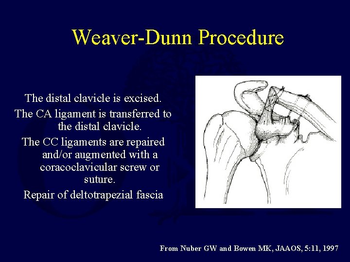 Weaver-Dunn Procedure The distal clavicle is excised. The CA ligament is transferred to the