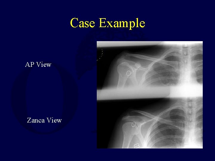 Case Example AP View Zanca View 