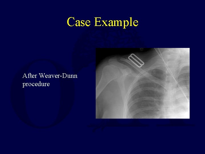 Case Example After Weaver-Dunn procedure 