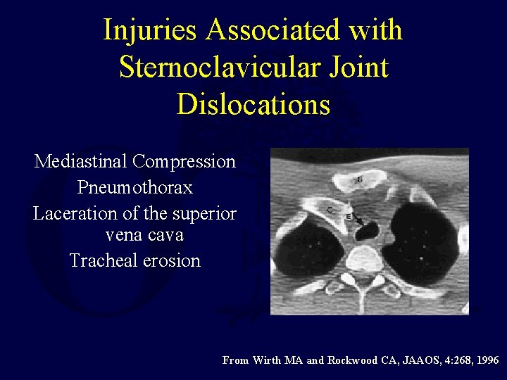 Injuries Associated with Sternoclavicular Joint Dislocations Mediastinal Compression Pneumothorax Laceration of the superior vena