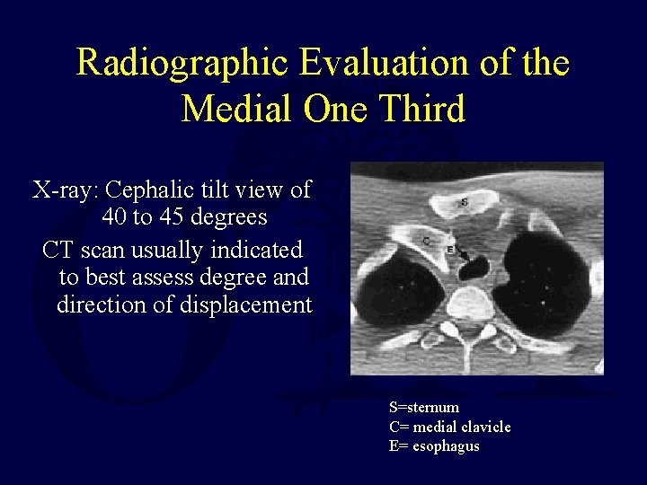 Radiographic Evaluation of the Medial One Third X-ray: Cephalic tilt view of 40 to