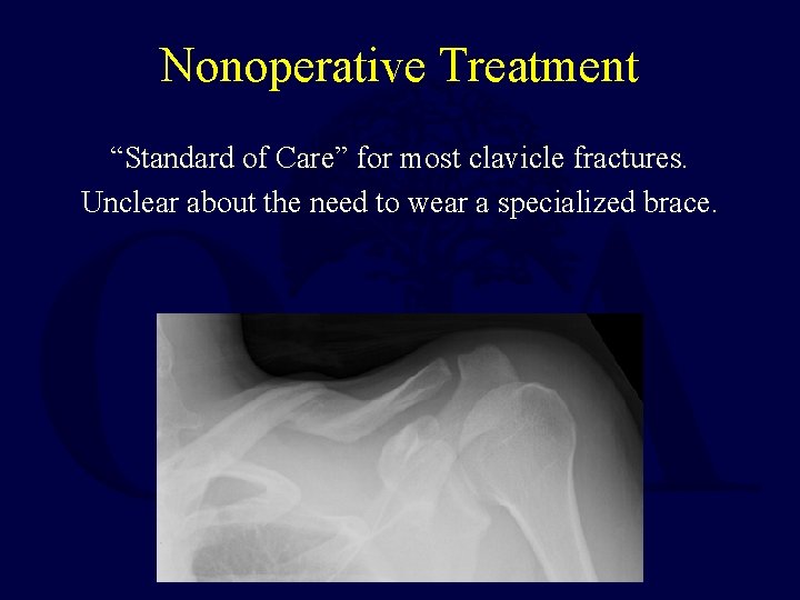 Nonoperative Treatment “Standard of Care” for most clavicle fractures. Unclear about the need to