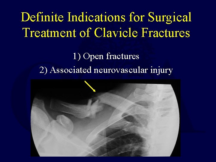 Definite Indications for Surgical Treatment of Clavicle Fractures 1) Open fractures 2) Associated neurovascular