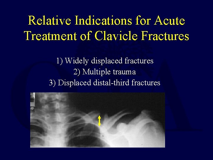 Relative Indications for Acute Treatment of Clavicle Fractures 1) Widely displaced fractures 2) Multiple