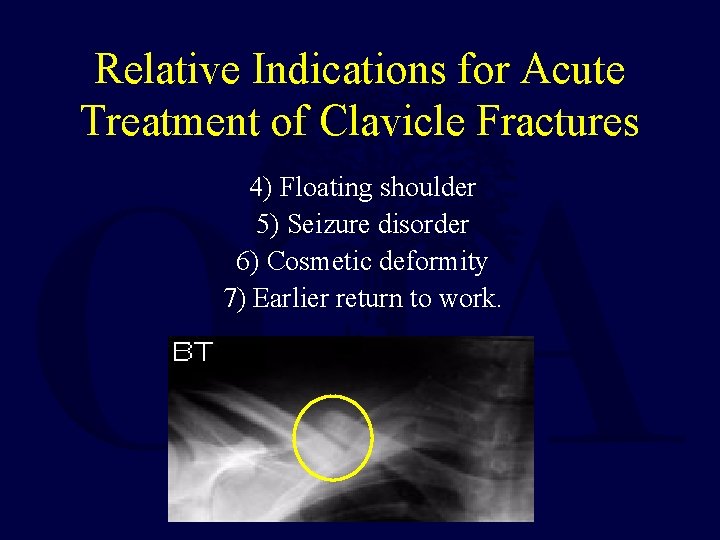 Relative Indications for Acute Treatment of Clavicle Fractures 4) Floating shoulder 5) Seizure disorder