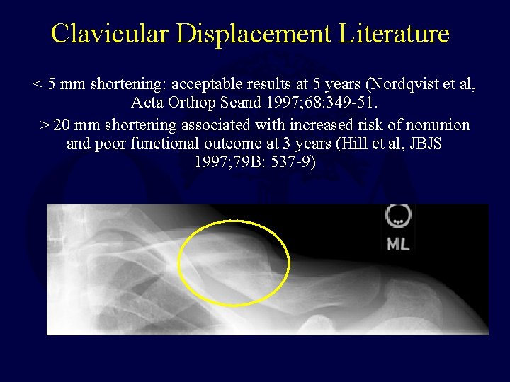 Clavicular Displacement Literature < 5 mm shortening: acceptable results at 5 years (Nordqvist et