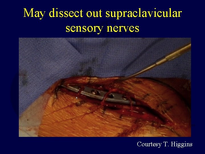 May dissect out supraclavicular sensory nerves Courtesy T. Higgins 