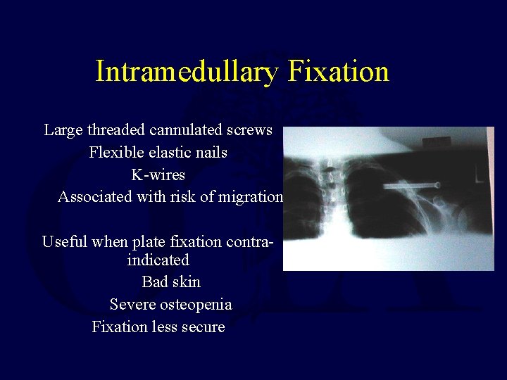 Intramedullary Fixation Large threaded cannulated screws Flexible elastic nails K-wires Associated with risk of