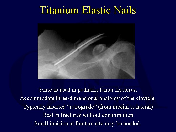 Titanium Elastic Nails Same as used in pediatric femur fractures. Accommodate three-dimensional anatomy of