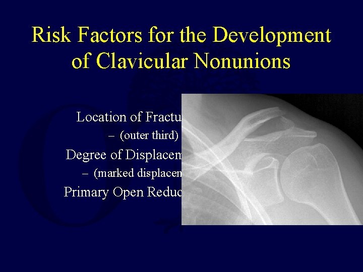 Risk Factors for the Development of Clavicular Nonunions Location of Fracture – (outer third)