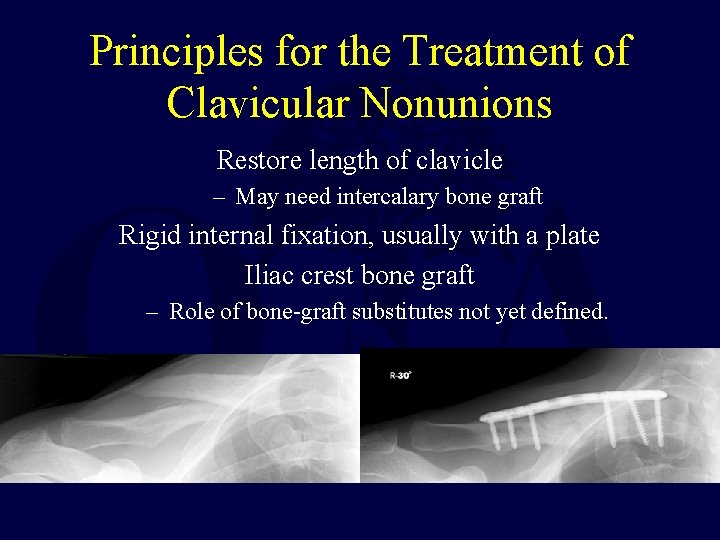 Principles for the Treatment of Clavicular Nonunions Restore length of clavicle – May need