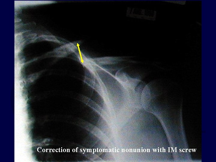 Correction of symptomatic nonunion with IM screw 