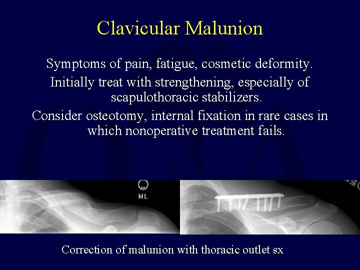 Clavicular Malunion Symptoms of pain, fatigue, cosmetic deformity. Initially treat with strengthening, especially of