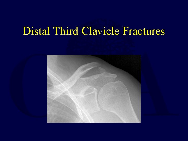 Distal Third Clavicle Fractures 