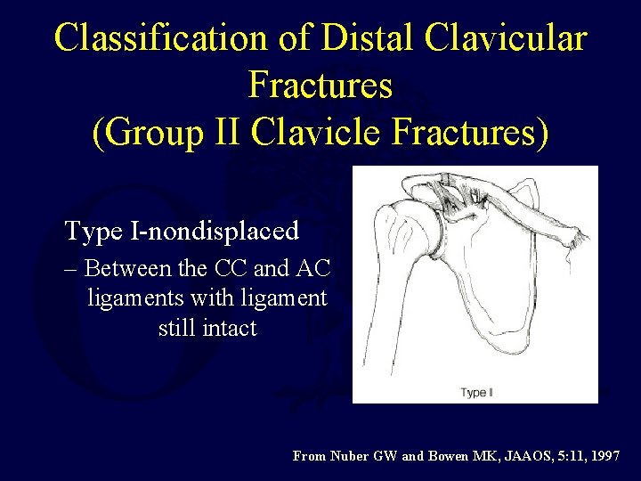 Classification of Distal Clavicular Fractures (Group II Clavicle Fractures) Type I-nondisplaced – Between the