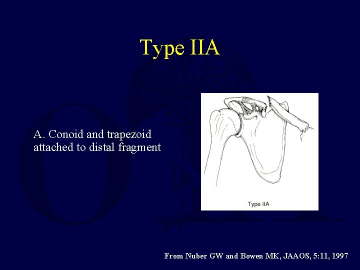 Type IIA A. Conoid and trapezoid attached to distal fragment From Nuber GW and