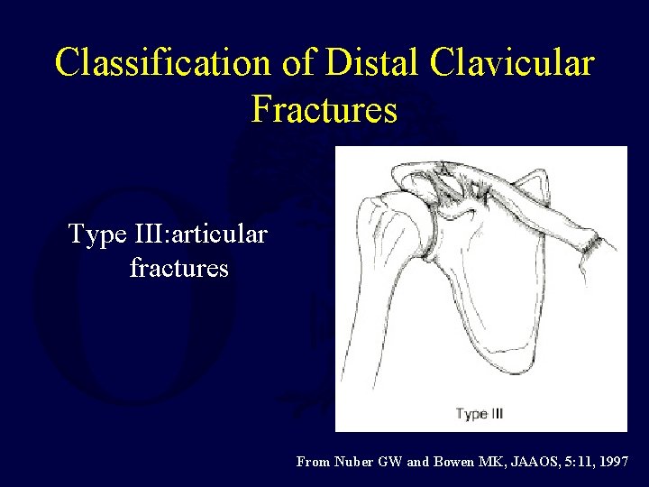 Classification of Distal Clavicular Fractures Type III: articular fractures From Nuber GW and Bowen