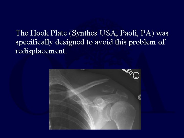 The Hook Plate (Synthes USA, Paoli, PA) was specifically designed to avoid this problem