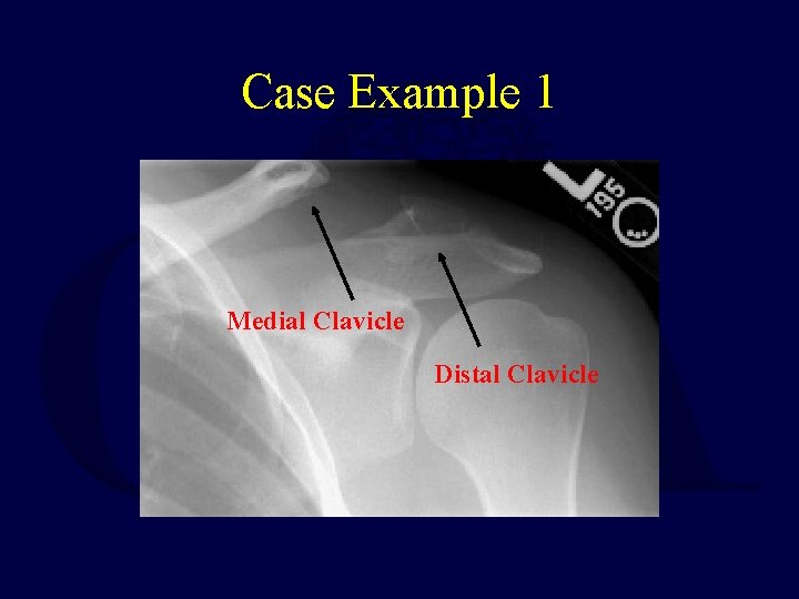 Case Example 1 Medial Clavicle Distal Clavicle 