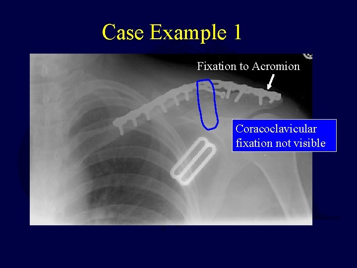 Case Example 1 Fixation to Acromion Coracoclavicular fixation not visible 