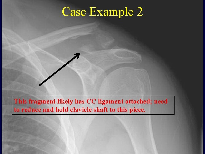Case Example 2 This fragment likely has CC ligament attached; need to reduce and